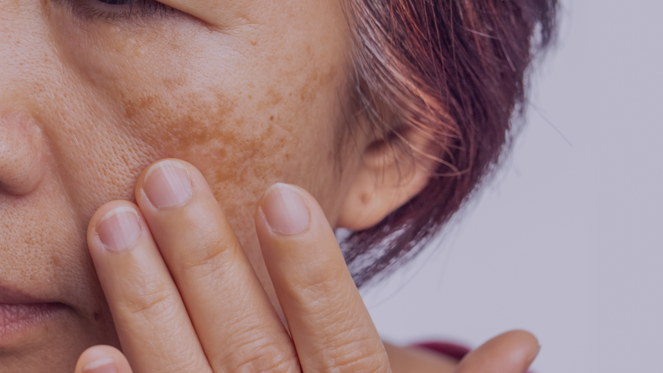 Ask Dr Jude: Why do some people get melasma and pigmentation?