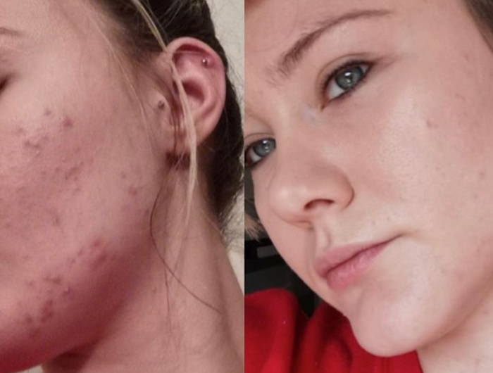 Acne & Oily Skin